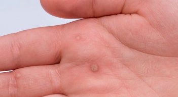 Virus del Papiloma Humano (VPH) 