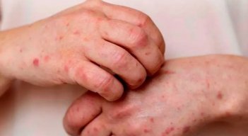 Se confirma segundo caso de mpox clado Ib en Colombia: se activó cerco epidemiológico de pasajero que llegó de Madrid a Bogotá